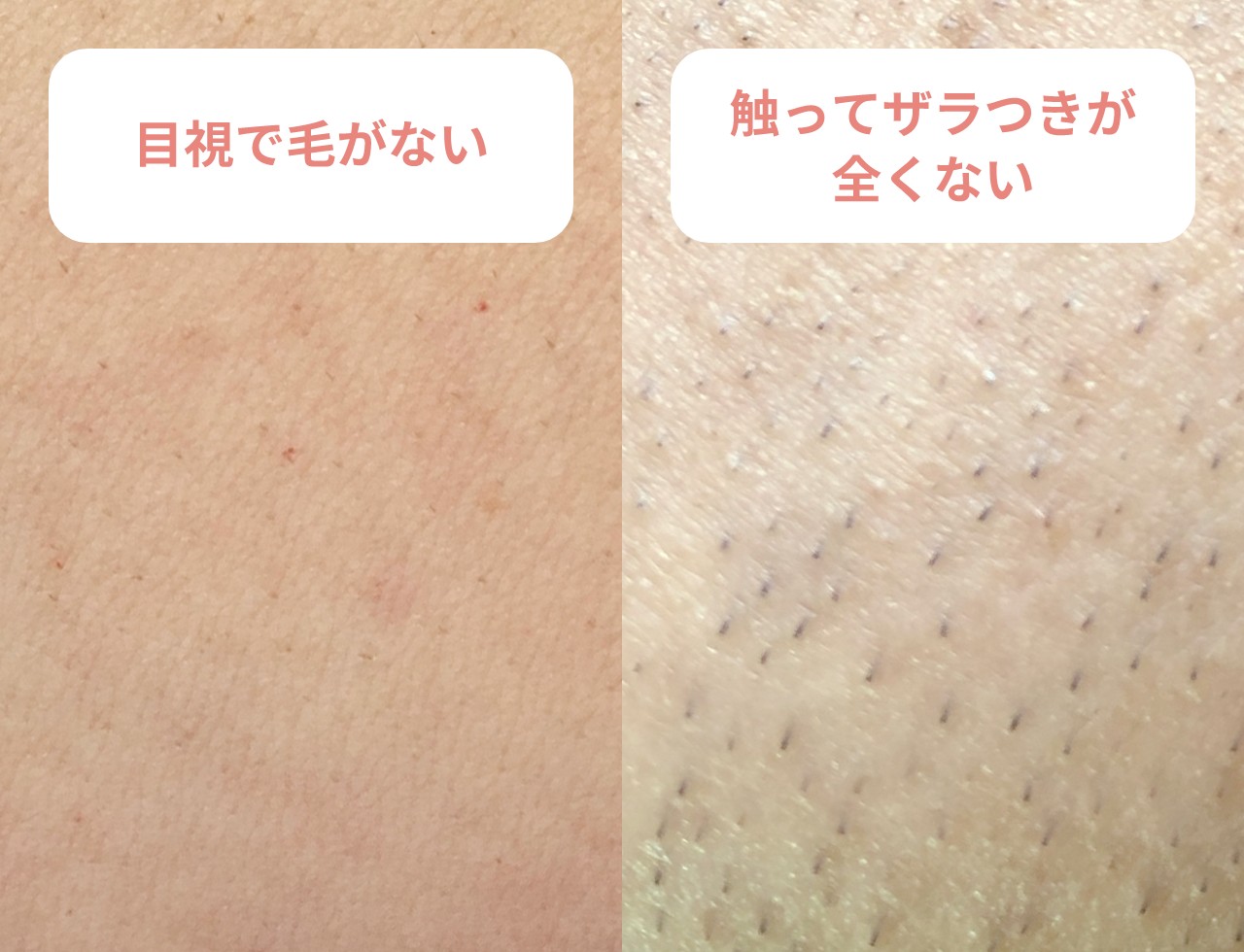 レーザー脱毛の料金はいくらくらいですか?