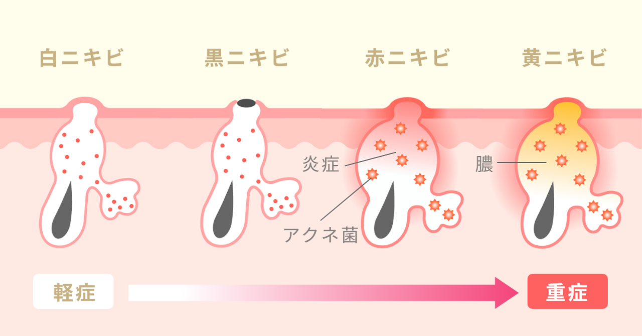 ニキビの種類と進行