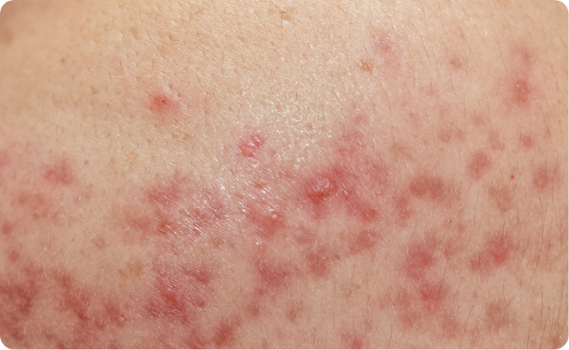 赤みのあるニキビ跡イメージ