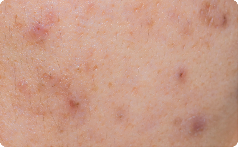 シミのようなニキビ跡イメージ