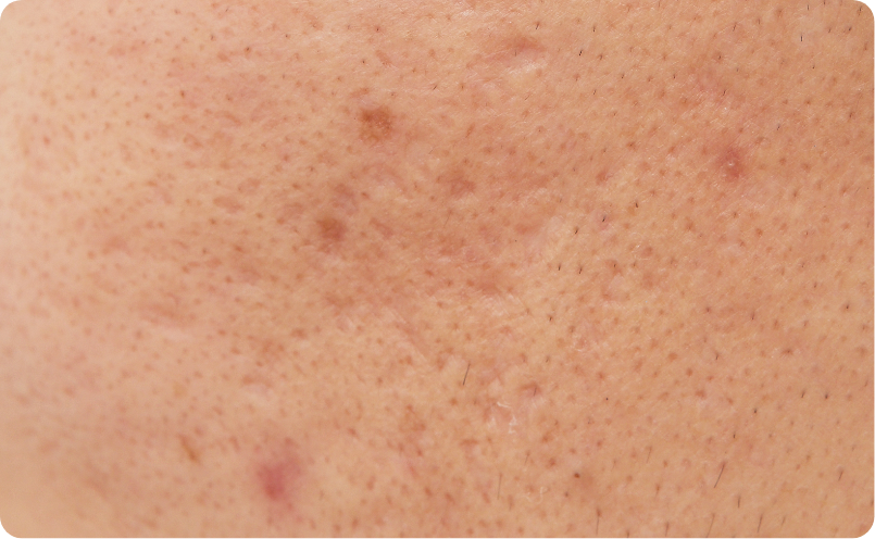 凸凹したニキビ跡（クレーター）イメージ