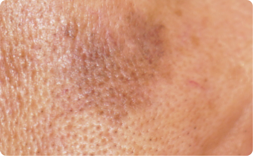 老人性色素斑イメージ