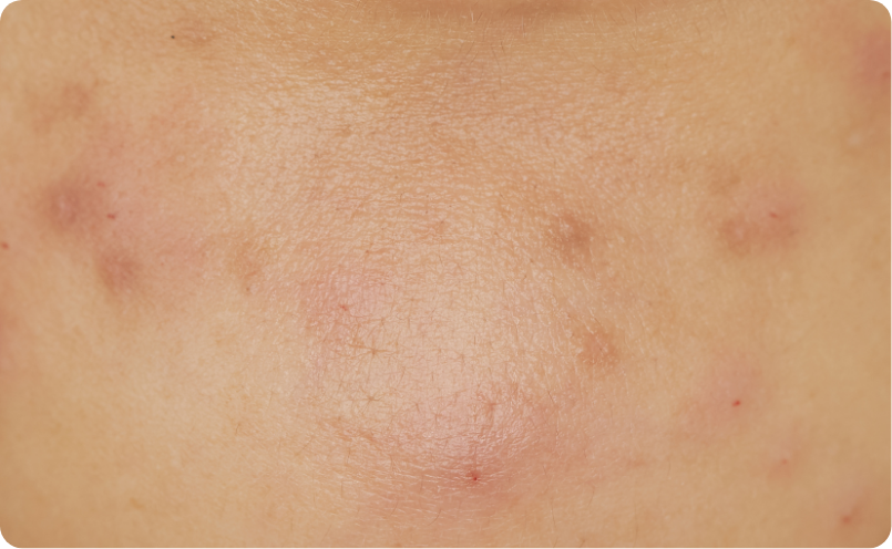 炎症後色素沈着イメージ