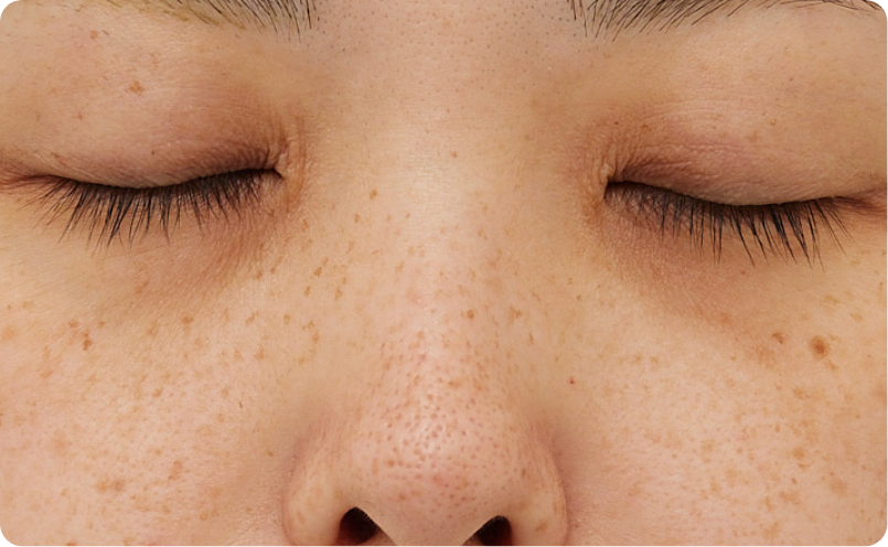 そばかすイメージ