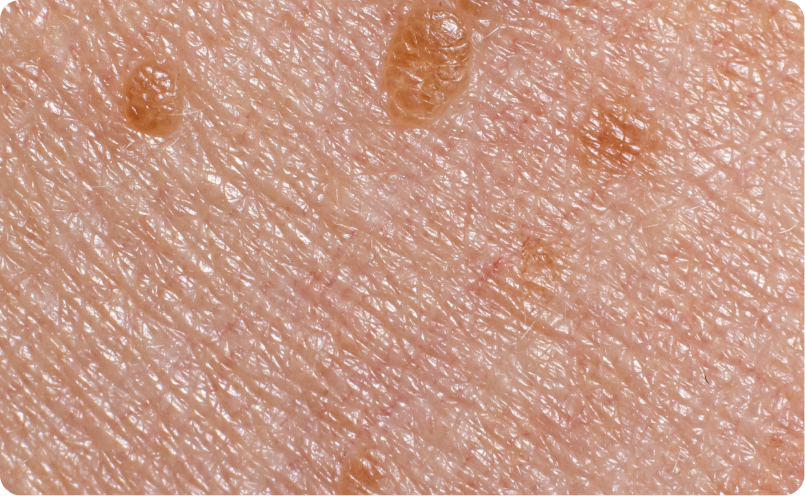 脂漏性角化症（イボ）イメージ