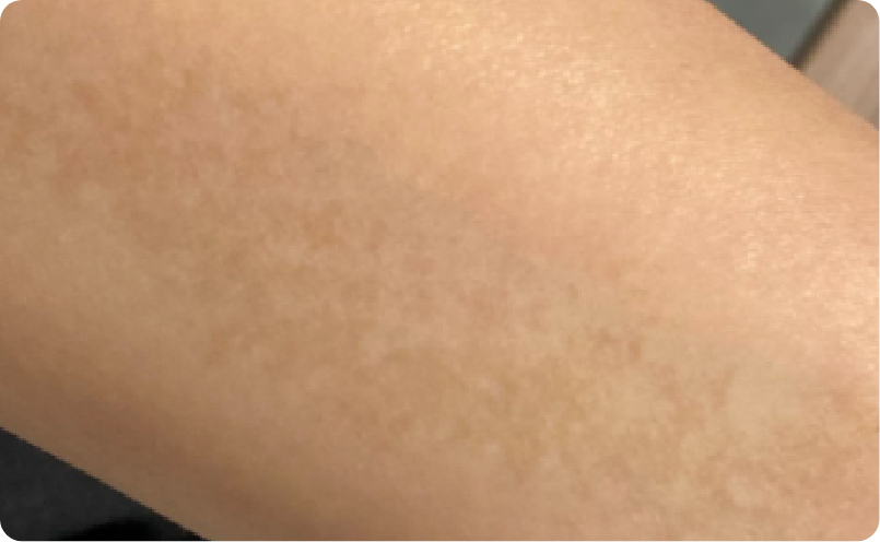 後天性真皮メラノサイトーシス（ADM）イメージ