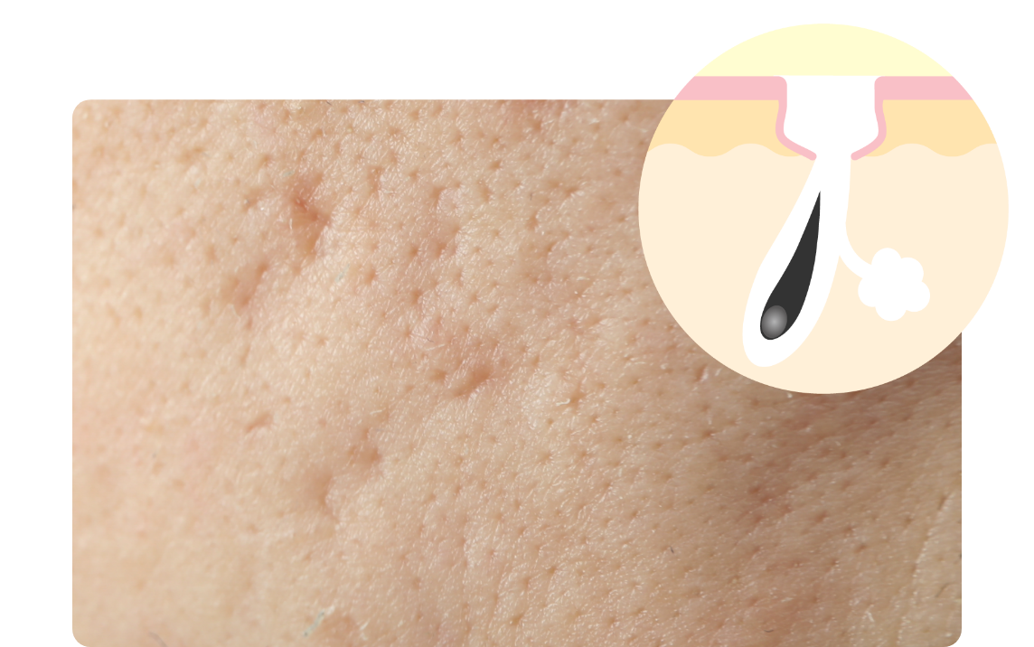 凹み毛穴イメージ