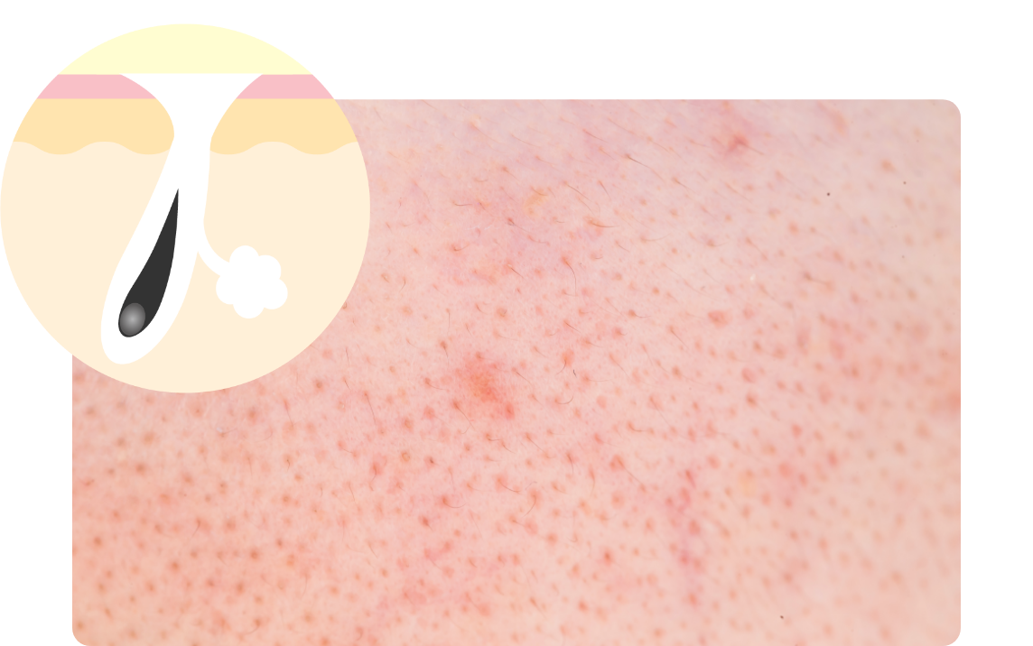 開き毛穴イメージ