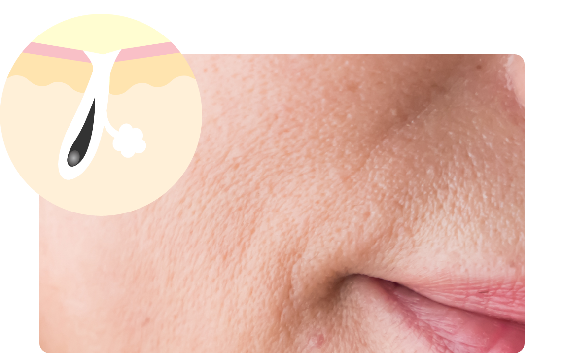 たるみ毛穴イメージ