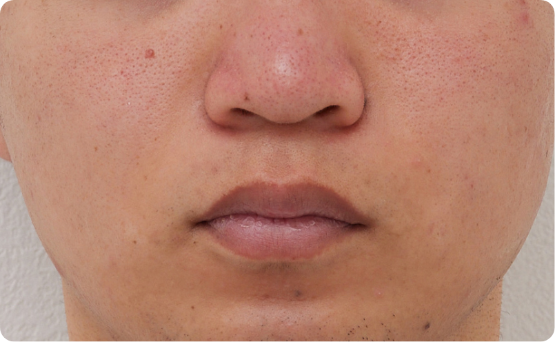 一時的赤ら顔イメージ