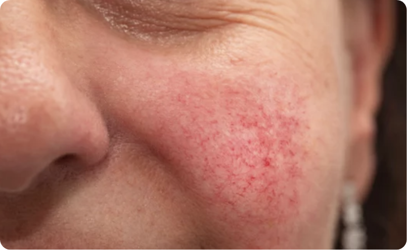 血管拡張型赤ら顔イメージ