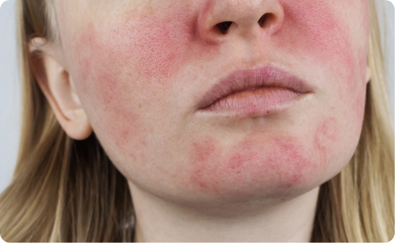 炎症型赤ら顔イメージ