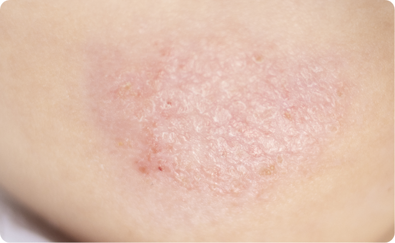 敏感肌型赤ら顔イメージ