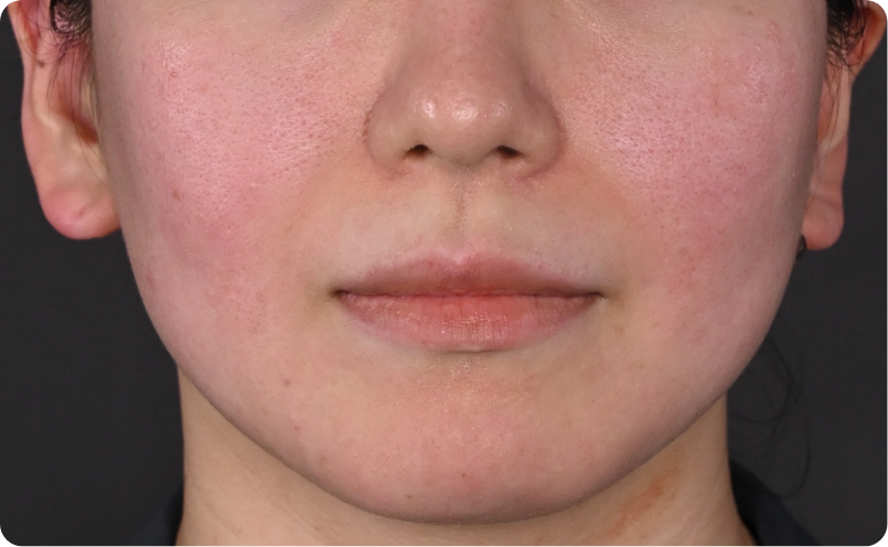 内因型赤ら顔イメージ