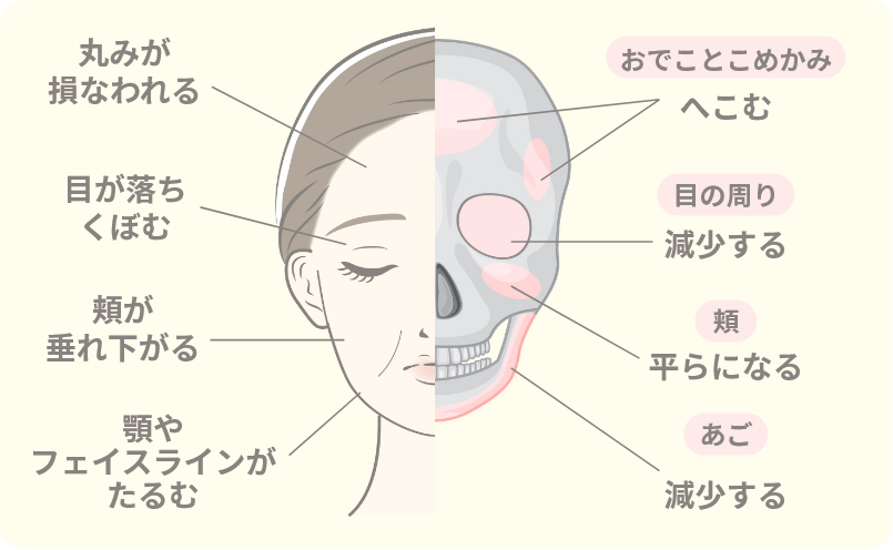 骨格の構造変化によるたるみイメージ