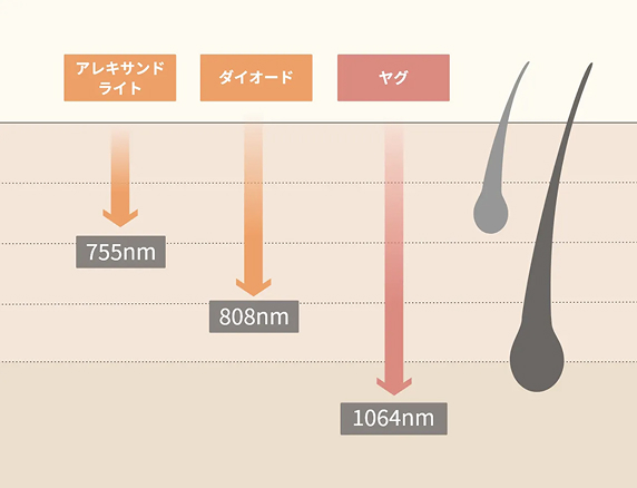 医療脱毛で使用される脱毛機の種類