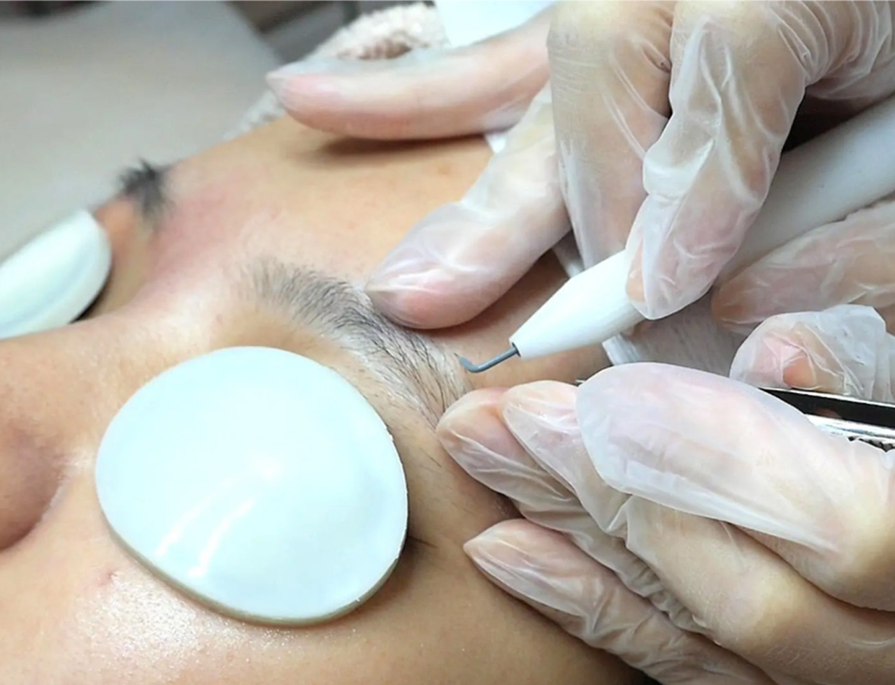 ニードル脱毛（針脱毛）は、増毛化・硬毛化対策に最適です。