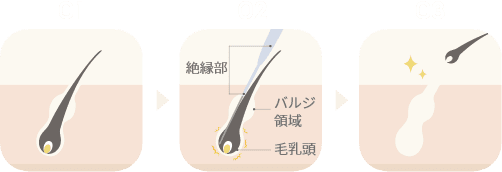 ニードル脱毛とは