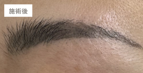 施術後の状態