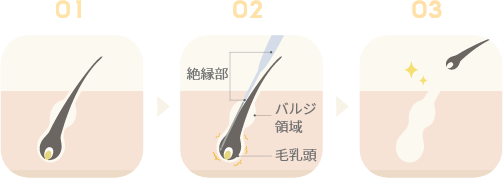 ニードル脱毛とは