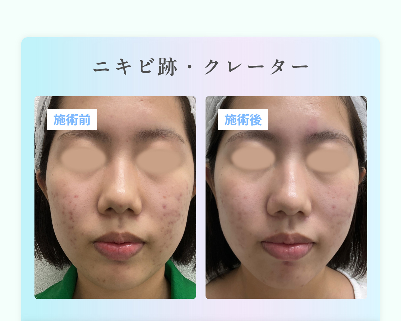ニキビ跡・クレーター