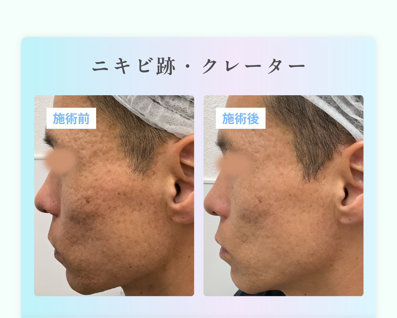 ニキビ跡・クレーター