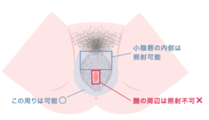 Iラインの粘膜部分は脱毛出来ますか 医療脱毛専門のリゼクリニック Iラインの粘膜部分は脱毛出来ますか 医療脱毛専門のリゼクリニック