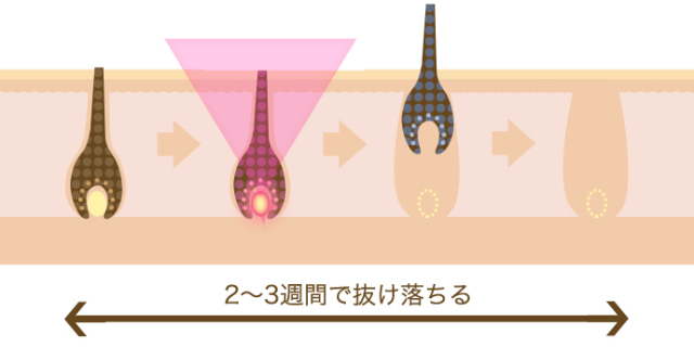 当院での打ち漏れについて 医療脱毛専門のリゼクリニック 当院での打ち漏れについて 医療脱毛専門のリゼクリニック