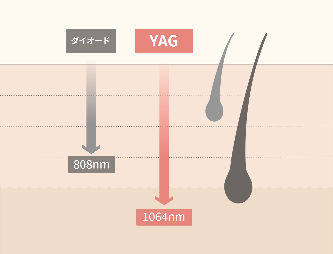 ダイオードレーザーとヤグレーザーの違いについて