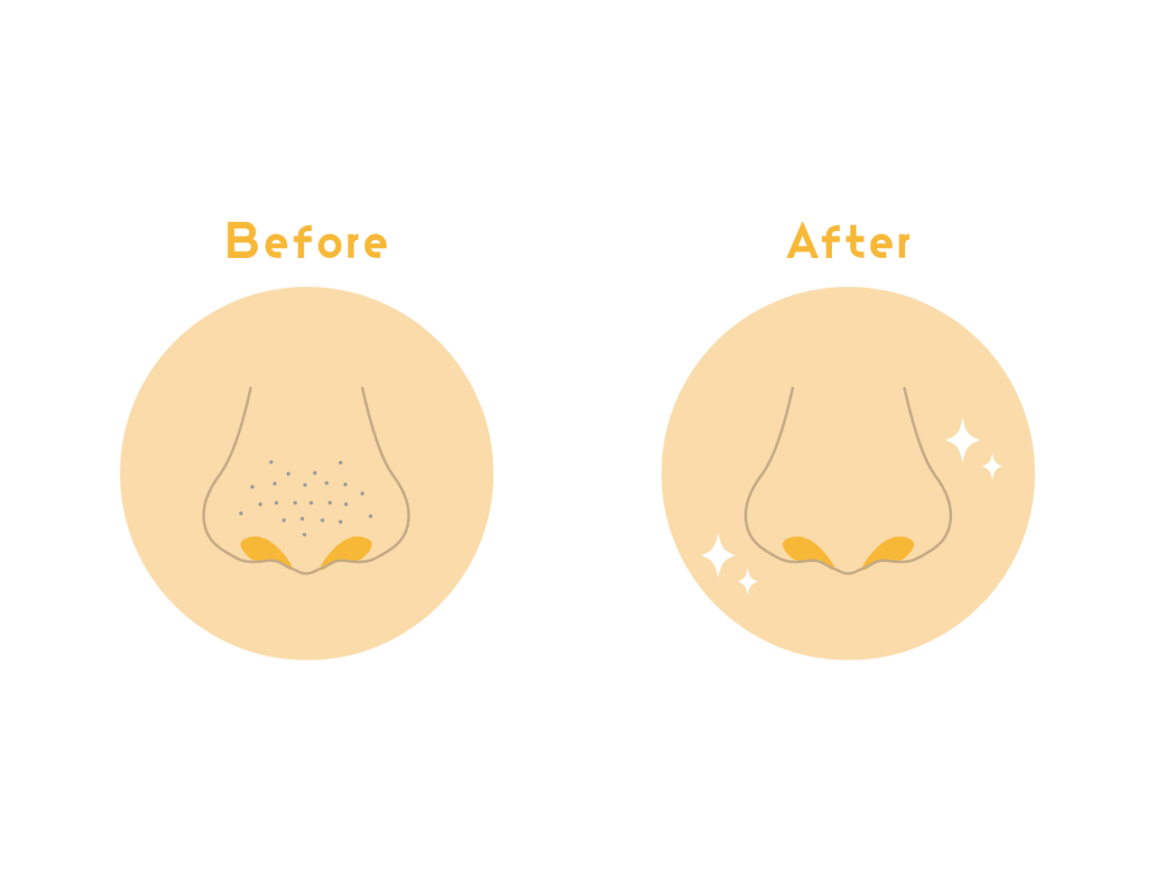 いちご鼻の原因は毛穴に蓄積した皮脂や角栓