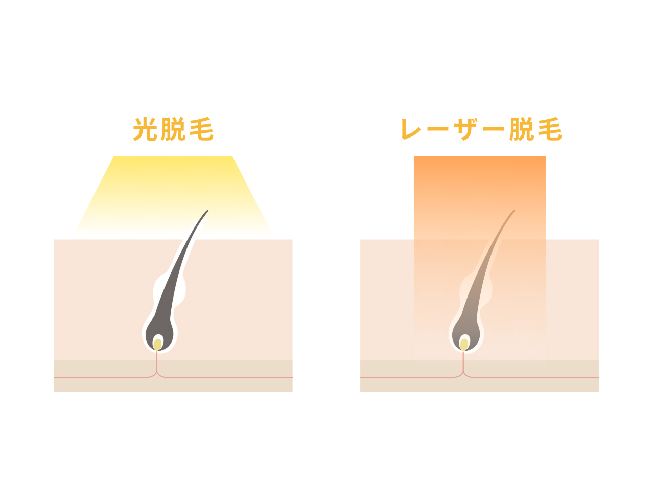 光脱毛とレーザー脱毛