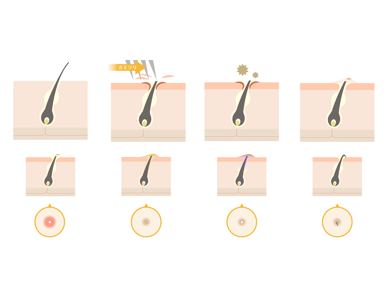 埋没毛（まいぼつもう）