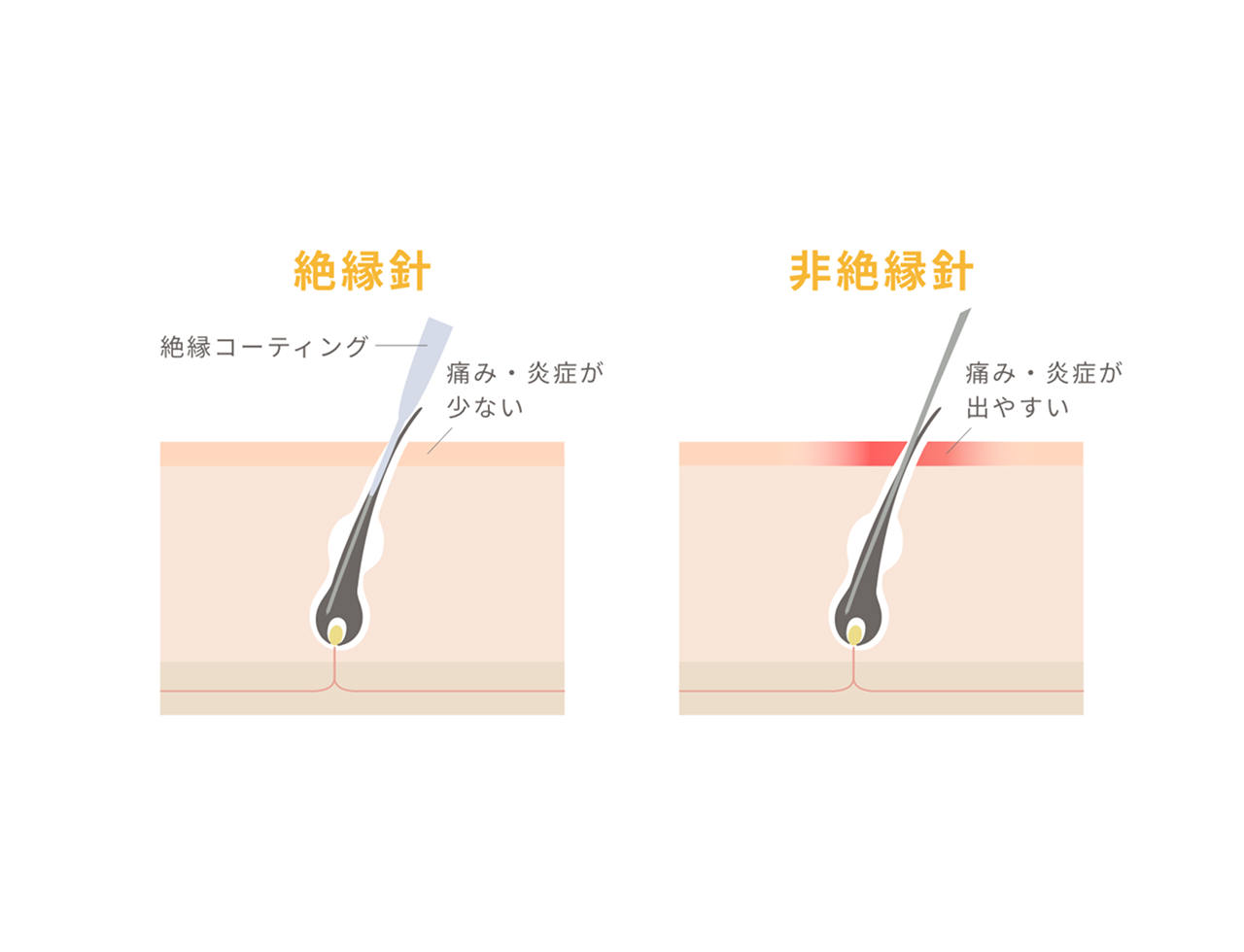 絶縁針と非絶縁針