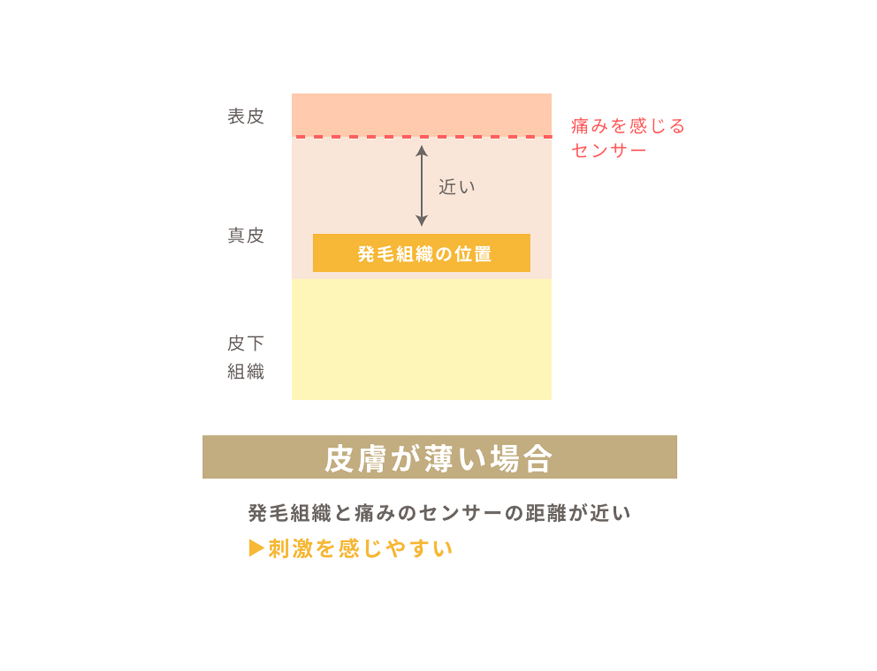 皮膚の厚さの違いによる、痛みの感じ方のイメージ