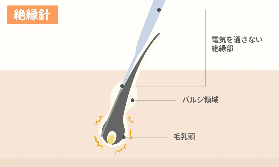 ニードル脱毛の施術イメージ