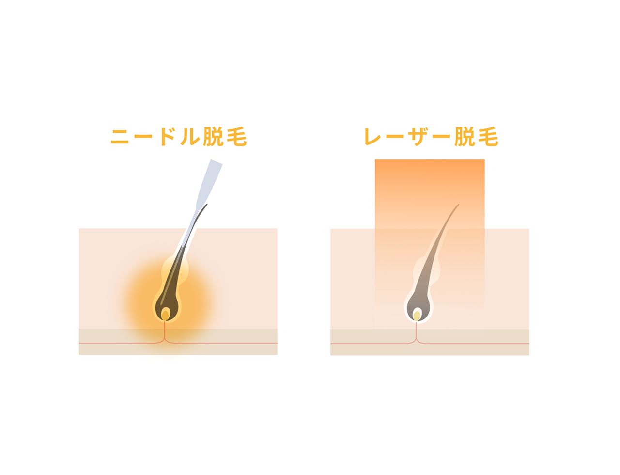 ニードル脱毛とレーザー脱毛の違い