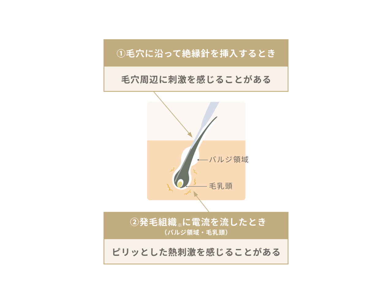 毛穴に沿って針を挿入し、電流を流して発毛組織を処理する仕組み