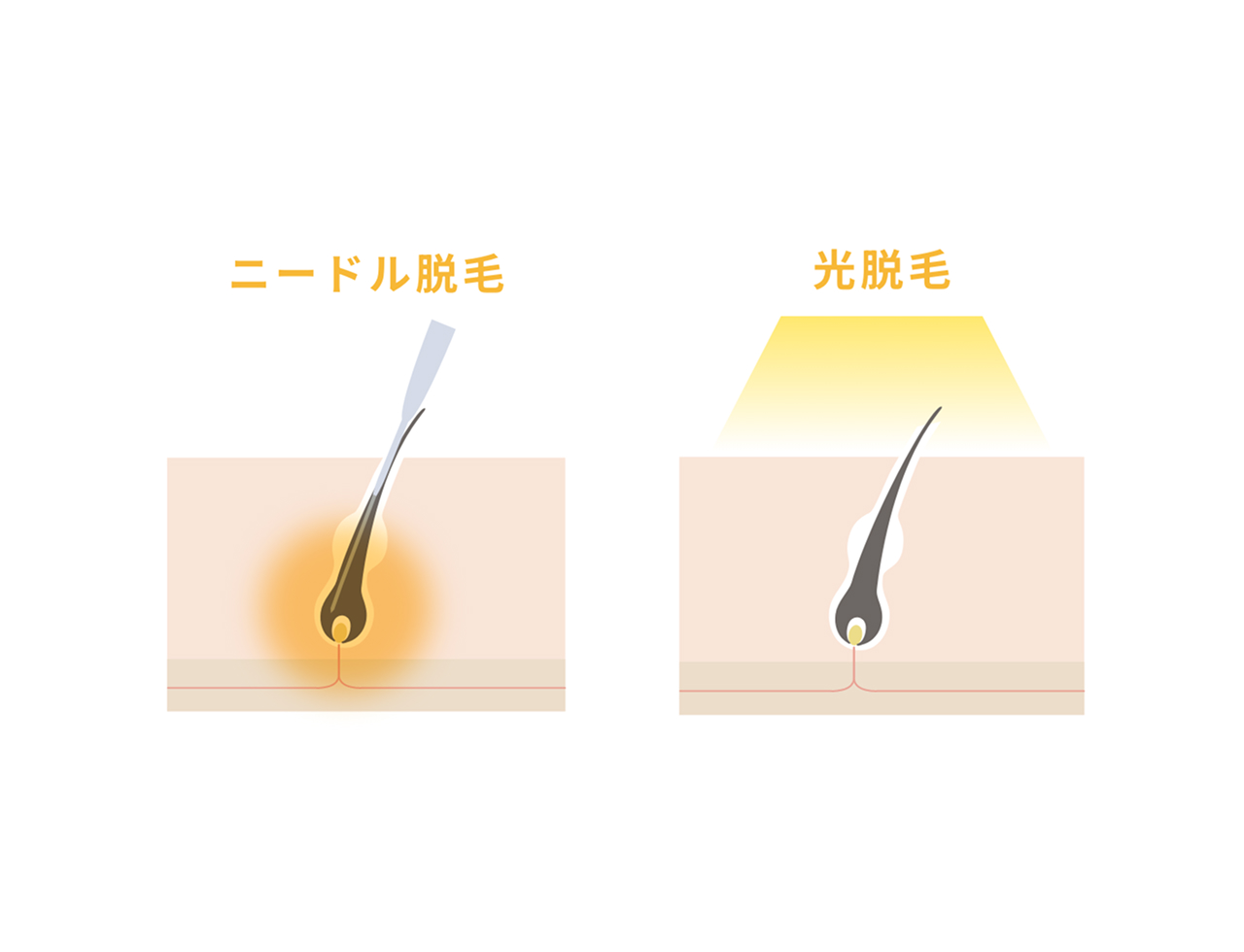ニードル脱毛と光脱毛