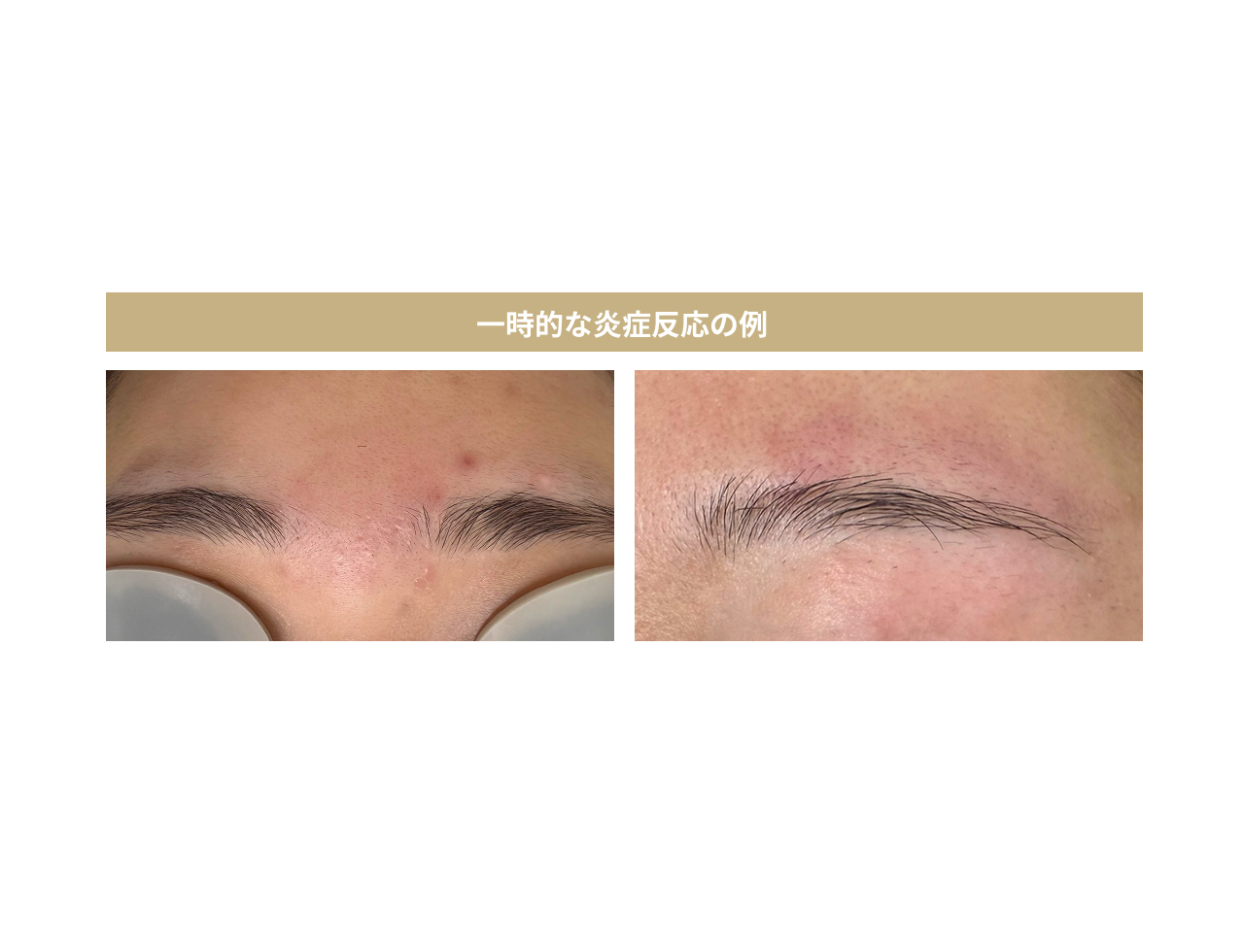 一時的な炎症反応の例