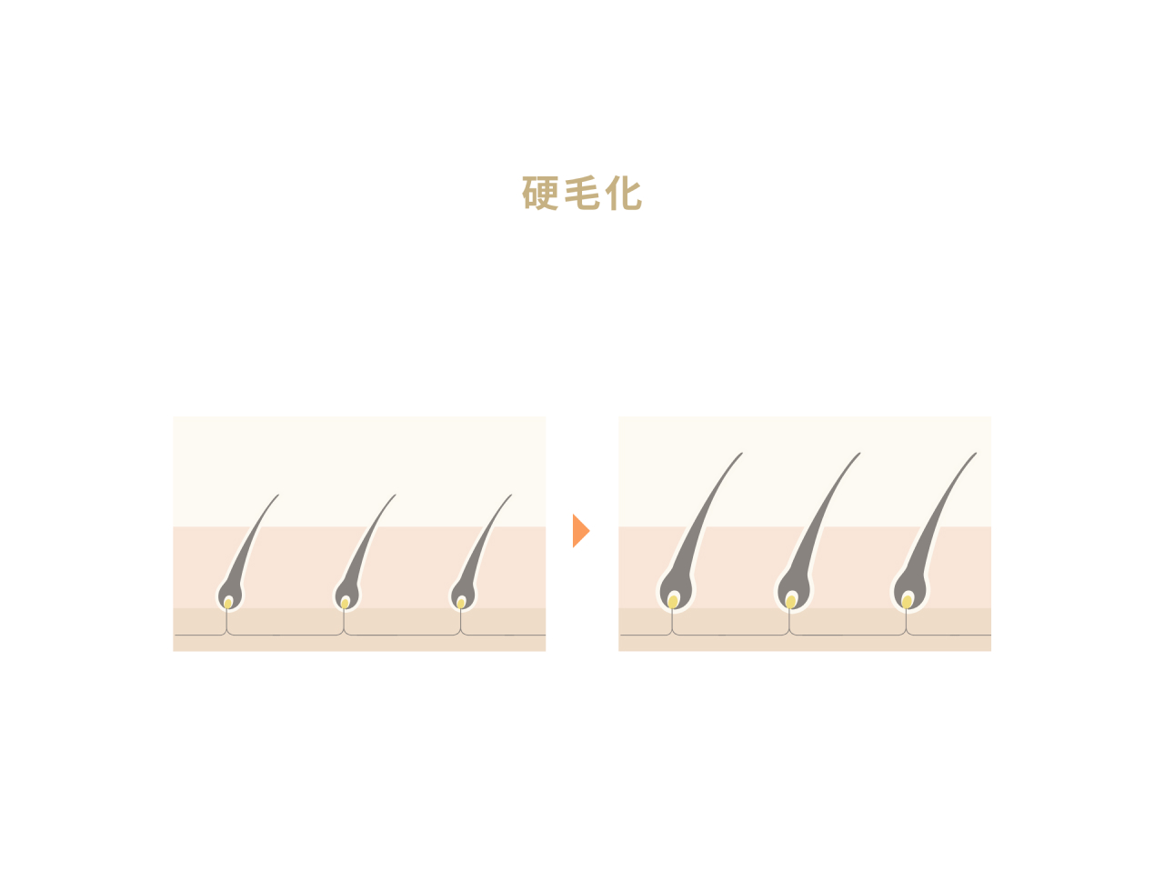 硬毛化の不安解消ガイド|脱毛後の発生率から予防策まで