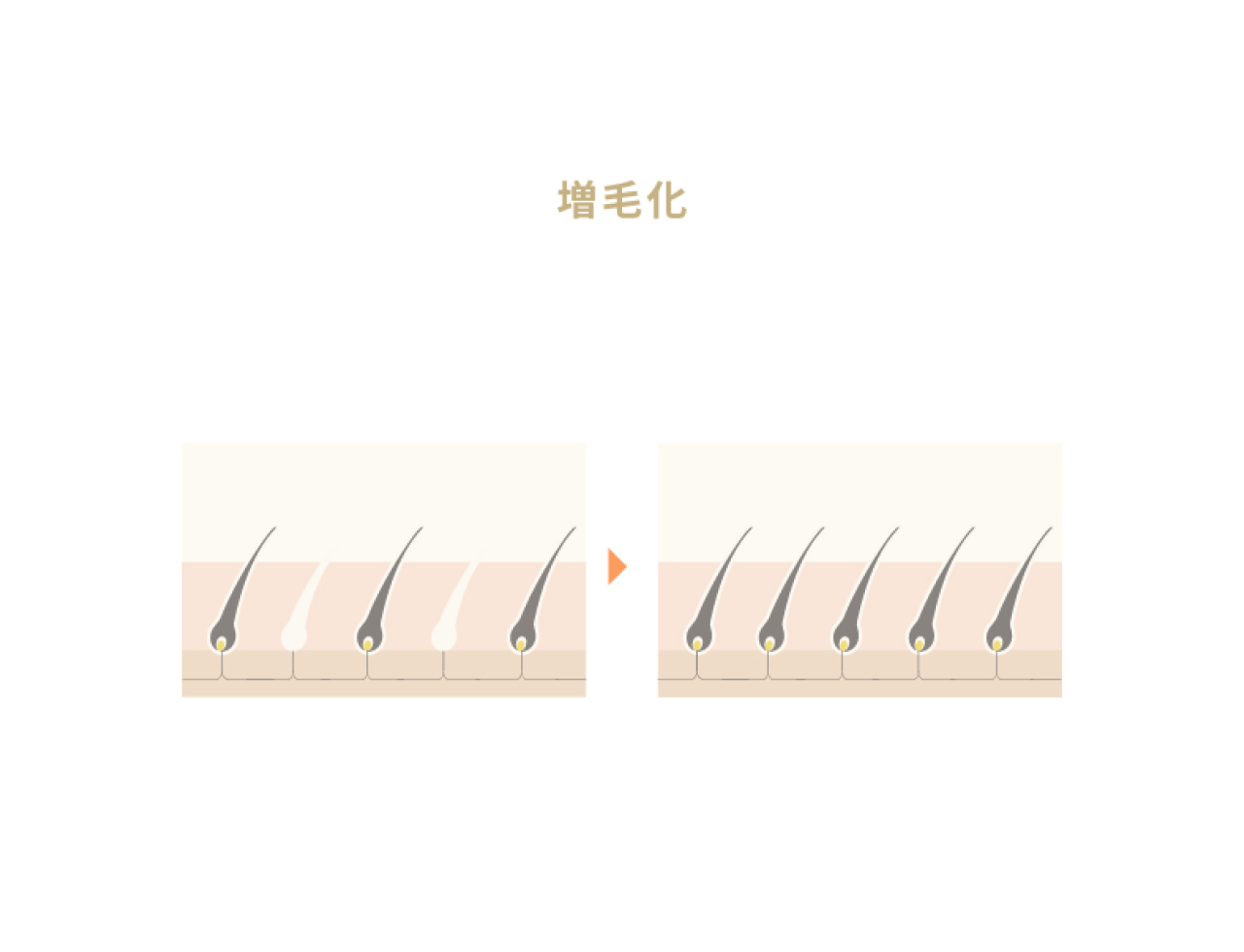 硬毛化の不安解消ガイド|脱毛後の発生率から予防策まで