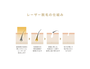 レーザー脱毛の仕組み