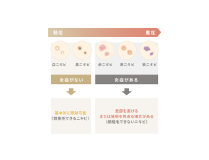 赤みや腫れのない白ニキビ・黒ニキビであれば、基本的には照射可能です。