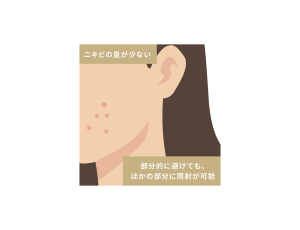 施術できるケース:ニキビの量が少ない