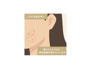 施術を避けたほうがいいケース:ニキビの量が多い